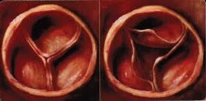 Les 4 valves du cœur